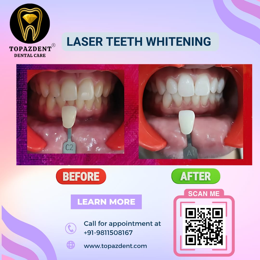Laser Teeth Whitening in Delhis